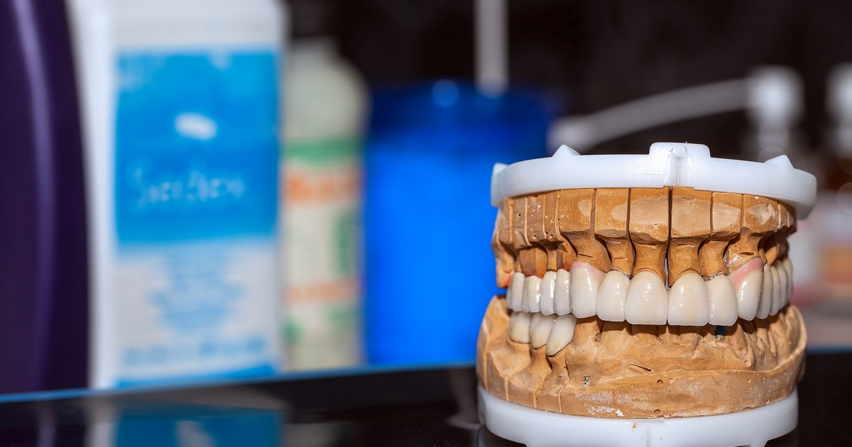 Modello dentale di protesi fissa su impianti All-on-6 nello studio di Brindisi