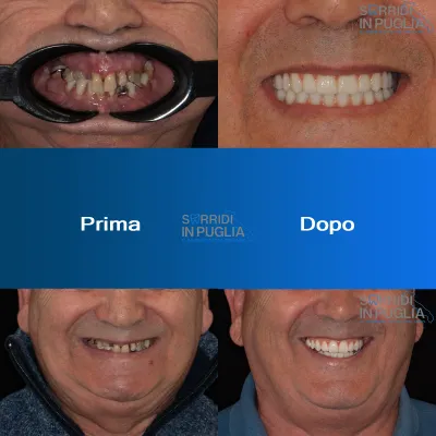 Impianti Dentali Puglia Sorridi In Puglia All On Four Prima E Dopo Superiore Ed Inferiore 1 1