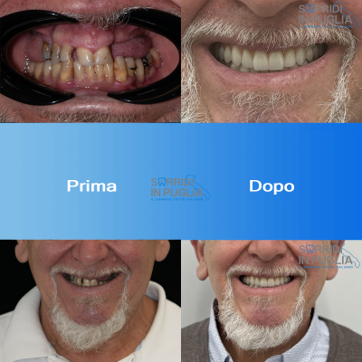 Impianti Dentali Puglia Sorridi In Puglia All On Four Prima E Dopo Superiore Ed Inferiore 1