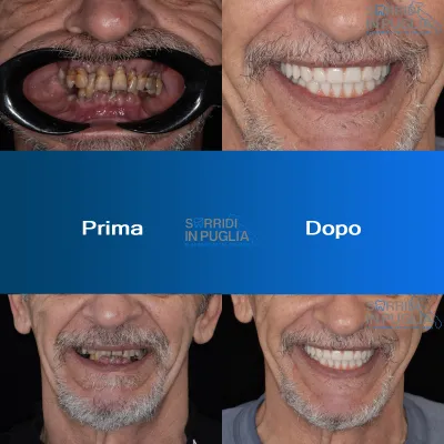 Impianti Dentali Puglia Sorridi In Puglia All On Four Prima E Dopo Superiore Ed Inferiore 2
