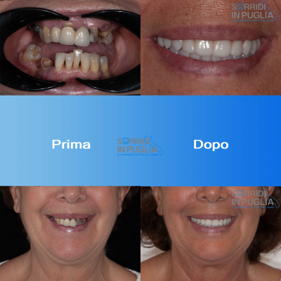 Impianti Dentali Puglia Sorridi In Puglia All On Four Prima E Dopo Superiore Ed Inferiore 